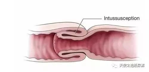 妈妈亲历，肠套叠差点要了我孩子的命！