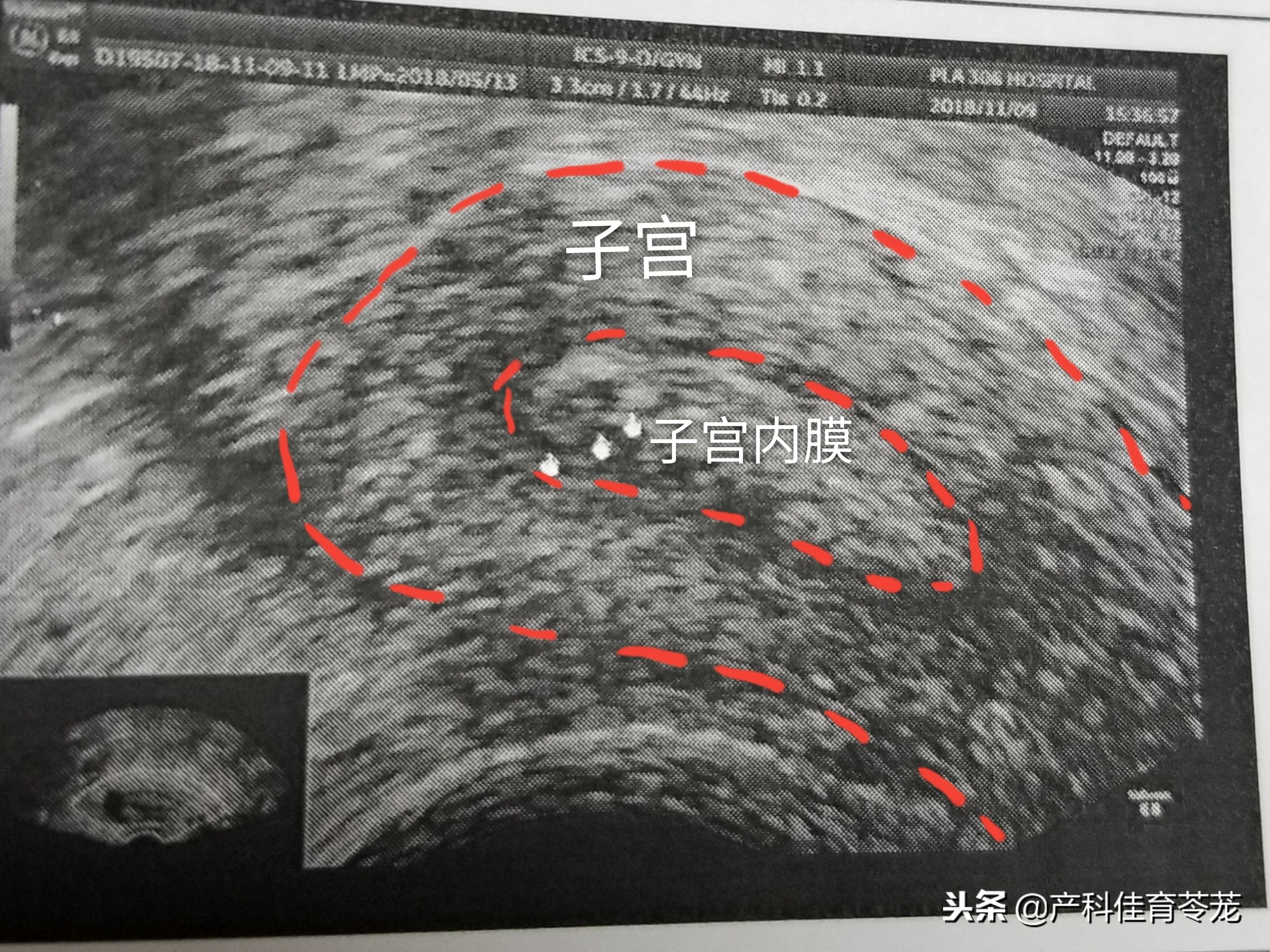 妇科b超是盆腔超声吗,妇科b超检查正常还需要做hpv吗