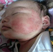 哪种湿疹膏最好用又安全,最好用的湿疹膏