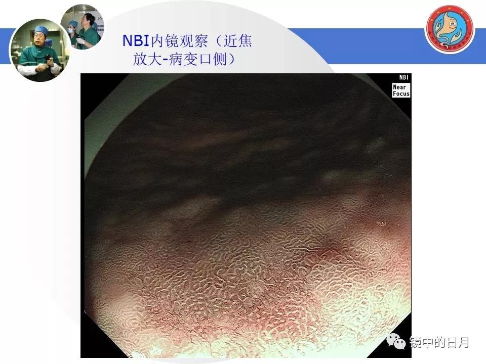 低分化胃癌早期时候做内镜手术吗,早期胃癌内镜手术后追加外科手术