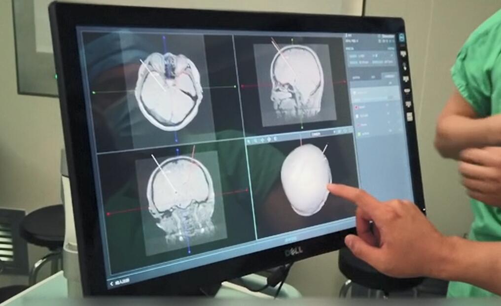 帕金森脑深部电极植入术护理问题,帕金森电极植入脑干