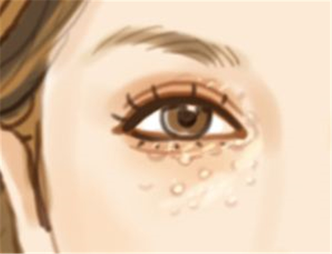 眼周围长出很多小疙瘩是怎么回事,眼睛长了个疙瘩能擦红霉素眼膏吗