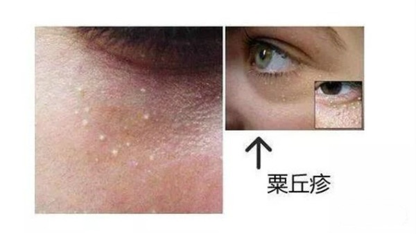 闭口顽固不消学会这招秒变鸡蛋肌,顽固痘痘痘印闭口怎么消除小妙招