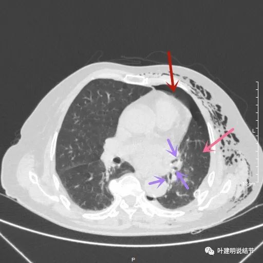 中央型肺癌手术前辅助治疗,中央型肺癌治疗后活过10年的病例