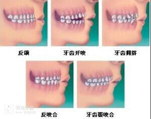 宝宝牙齿地包天怎么矫正,宝宝地包天5岁如何矫正