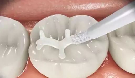 做窝沟封闭痛苦吗，价位多少？做爸妈的应该提前知道这些