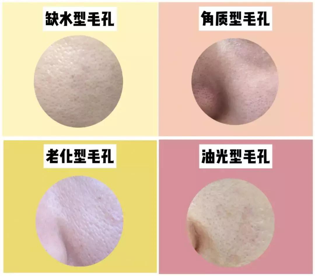 毛孔黑粗大收缩毛孔最有效的方法,毛孔粗大怎么办教你几招收缩毛孔