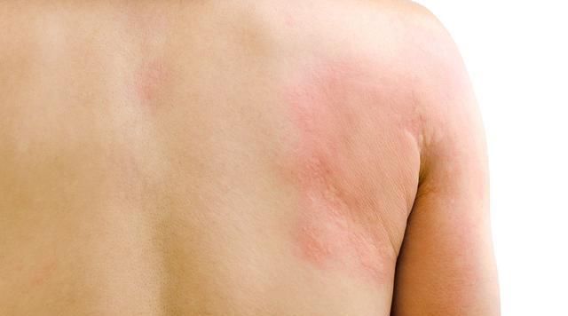 湿疹、*麻疹荨**、皮炎反复折磨,有效治疗彻底摆脱皮肤病