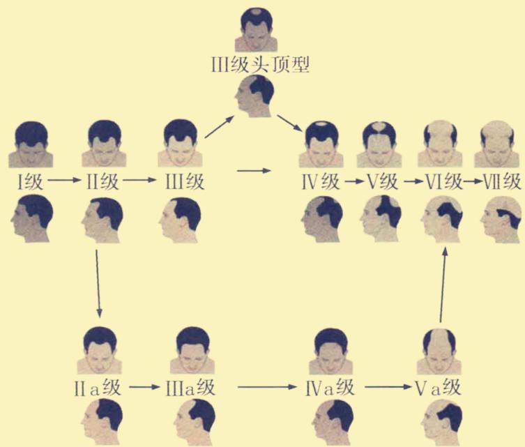 #你离秃头有多远#秃发——其实就是一种疾病