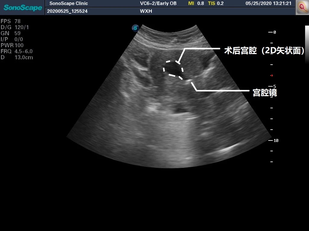 轻微宫腔粘连手术成功案例,轻度宫腔粘连分离术是大手术吗
