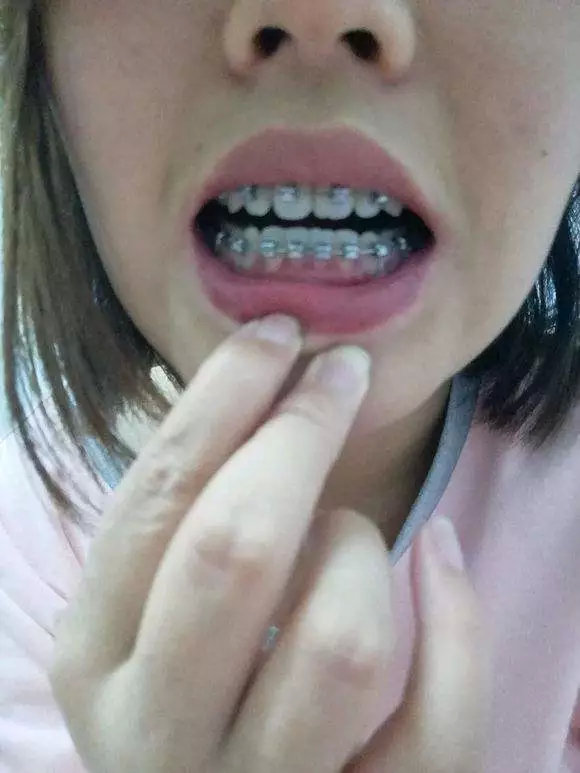 矫牙经历的几个阶段,矫牙过程难受吗