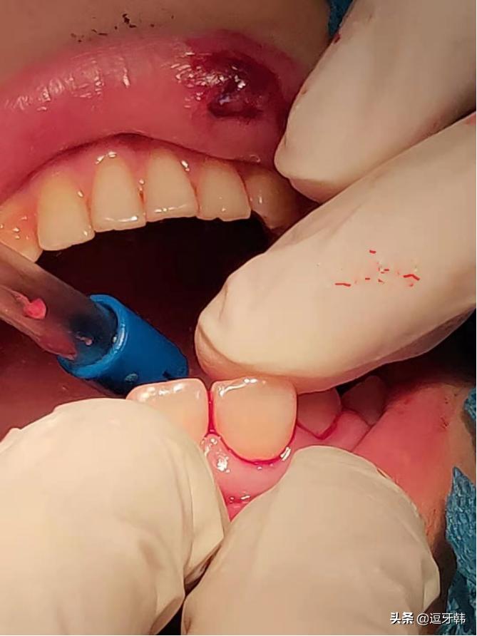 骑车摔伤牙齿松动怎么办,牙齿摔伤会引起发烧吗