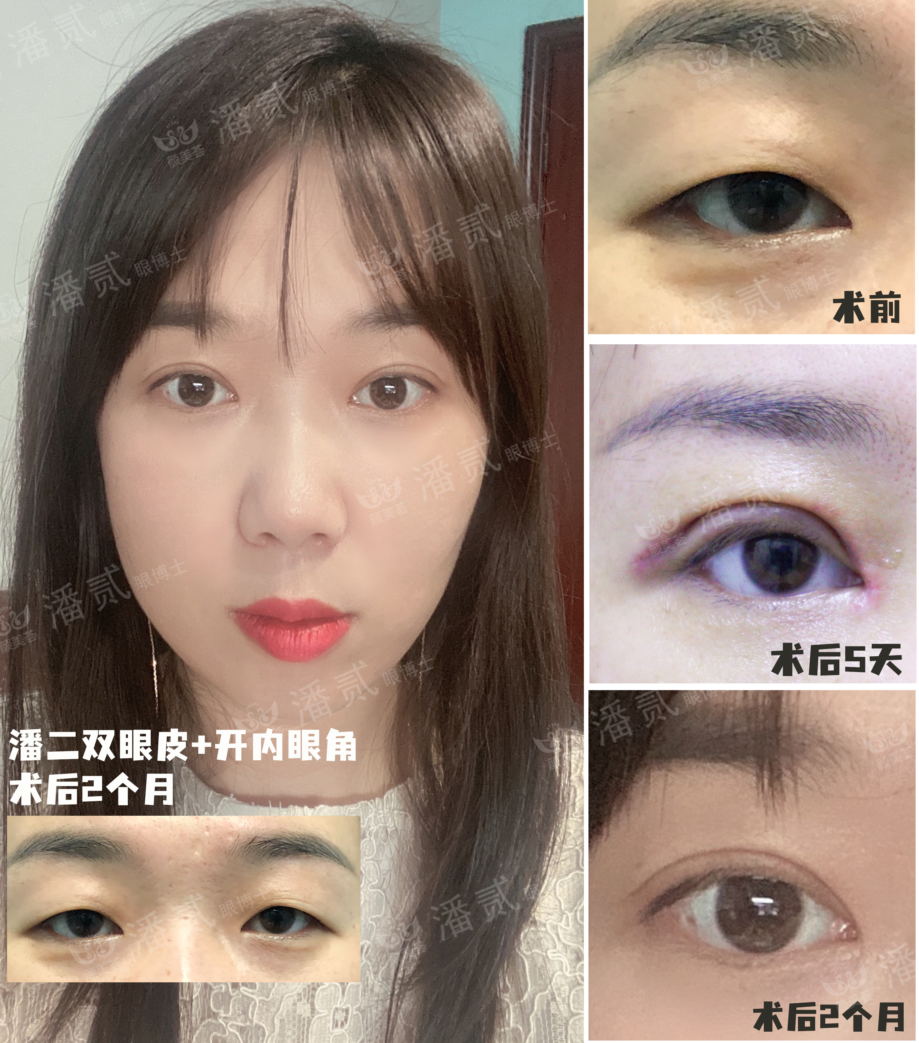 双眼皮眼尾割长了而且上扬怎么办,眼睛眼尾下垂做什么样双眼皮