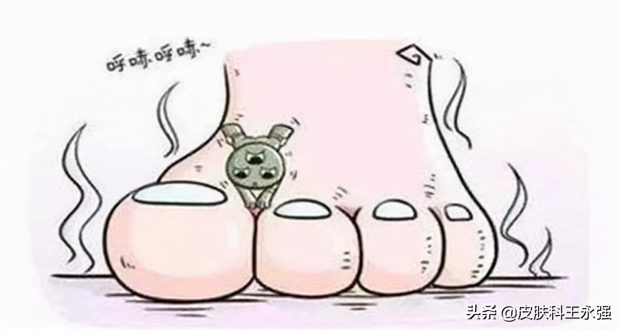 脚气如何根除教你四个方法,夏天脚气怎么根除小妙招