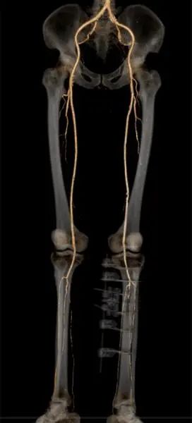 糖尿病足手术后又坏死怎办,糖尿病足部溃烂截肢手术