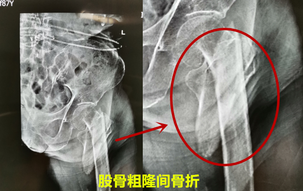 老人一屁股摔倒脊柱骨折如何治疗,老人一屁股坐地上怎么处理