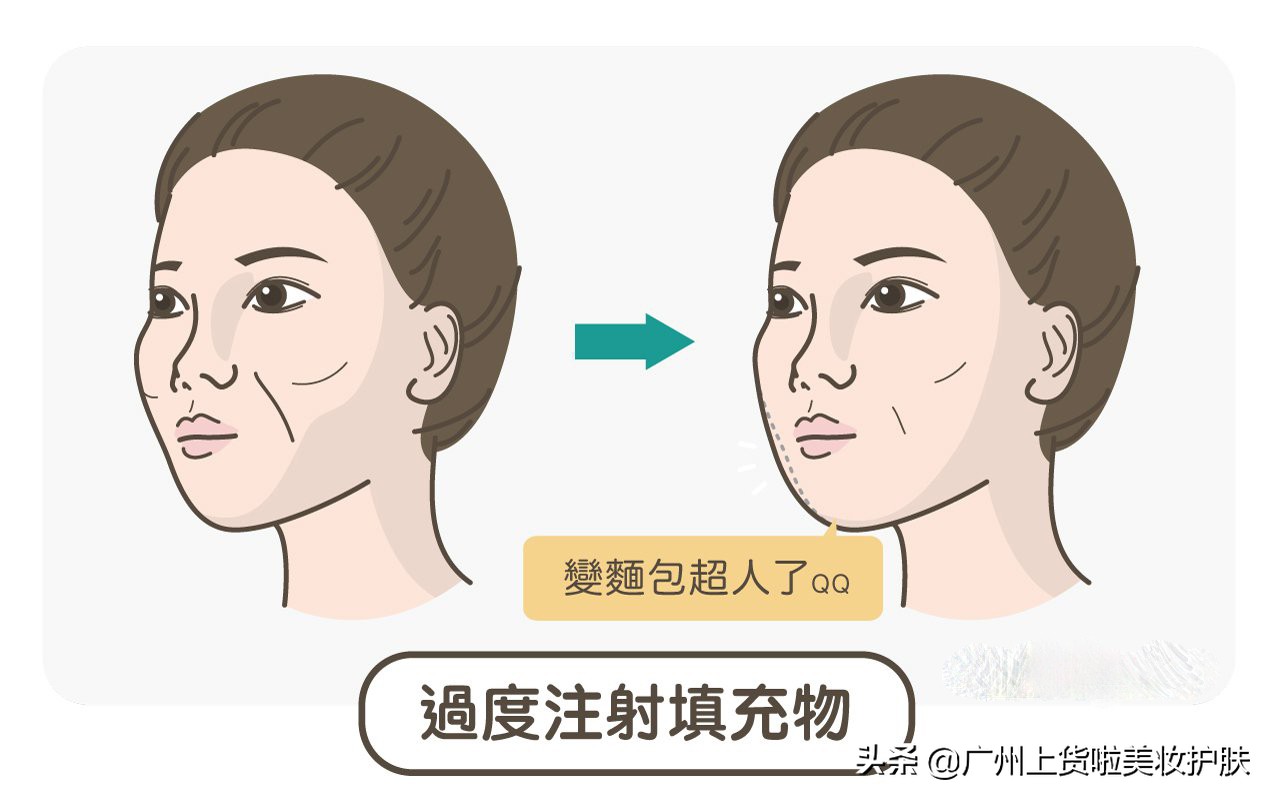 法令纹比较深最有效的办法,法令纹的种类及改善方法
