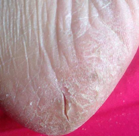 如何去除真菌部位的硬角质,角质去除小妙招