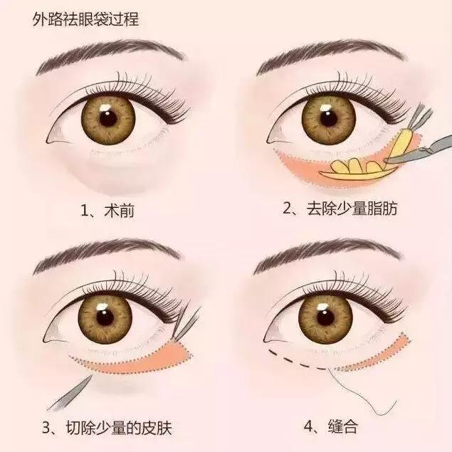 眼袋怎么消除简单方法男生,黑眼袋怎么消除最快方法男士