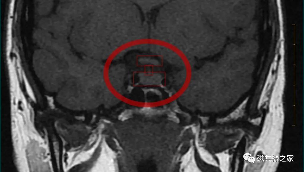 垂体mri扫描,垂体微腺瘤mri扫描