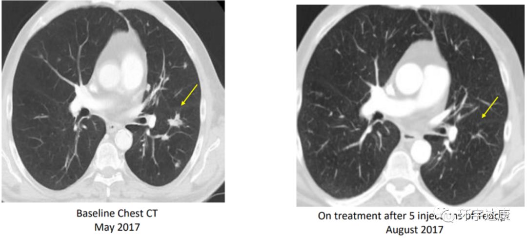 癌症疫苗最新研制进展,唯一一个预防癌症的疫苗