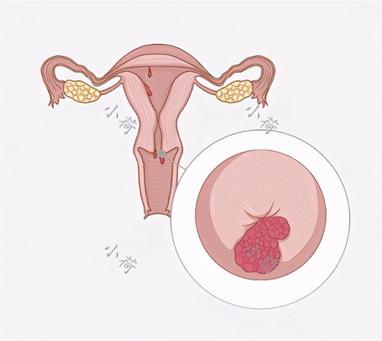 56岁女性出血疑似子宫癌,阴道持续出血宫颈癌早期10种症状