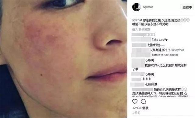 换季过敏起疹子用什么药,脸换季过敏起疹子