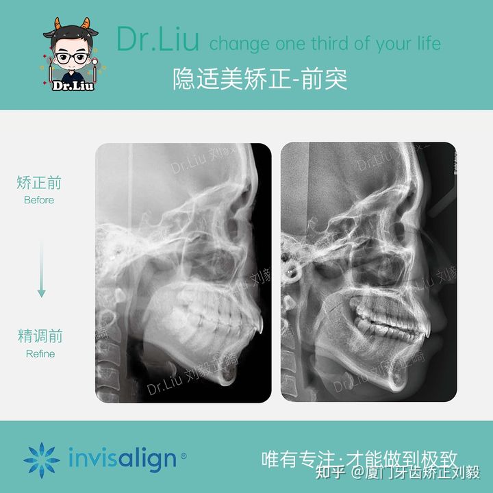 正畸临床拔牙矫治,拔牙正畸矫正嘴凸案例