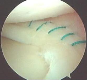 膝关节软骨移植手术风险大吗,膝关节软骨移植手术后多久能康复