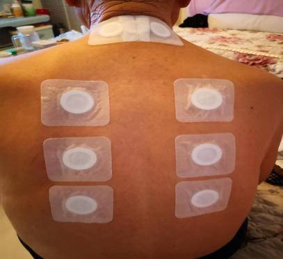 兖矿新里程总医院中医科主任,三伏贴医院贴的视频