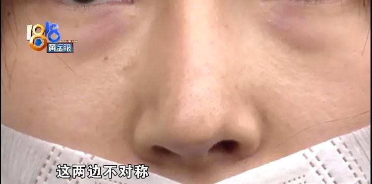 鼻子突然变暗变红,想要鼻子变高的方法