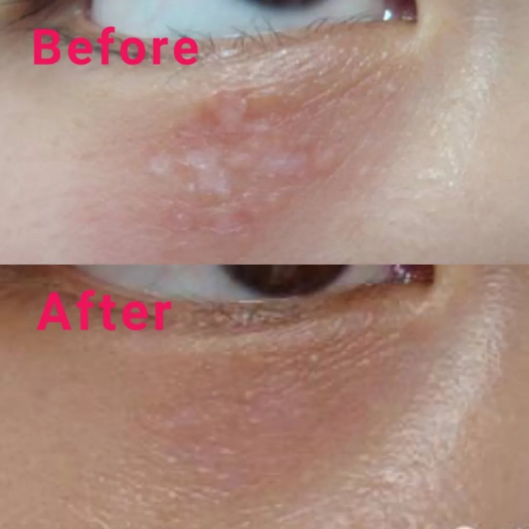 夏天出汗眼睛周围起疙瘩怎么回事,脸上眼睛周围有小米粒那样的疙瘩