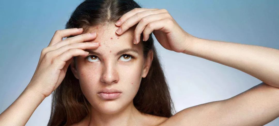 腋下痘痘挤出白色米粒是什么,痘痘里面挤出小米粒是不是就好了