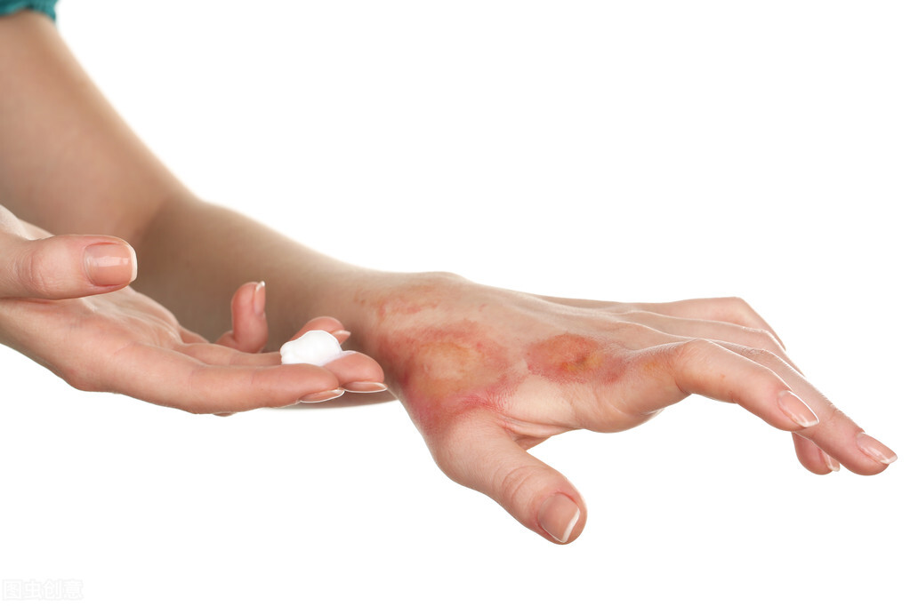 开水烫伤用什么涂一涂,香油兑石灰粉治疗烫伤过程