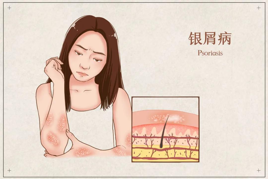 倪海厦讲皮肤红斑治疗方法,红斑鳞屑性皮肤病日常注意