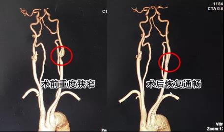 80岁了颈动脉狭窄还有手术必要吗,80岁颈动脉狭窄90%可以保守治疗吗