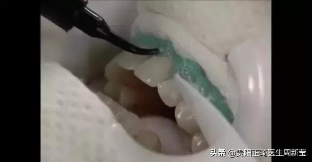 冷光美牙仪的危害,朋友圈冷光美牙仪