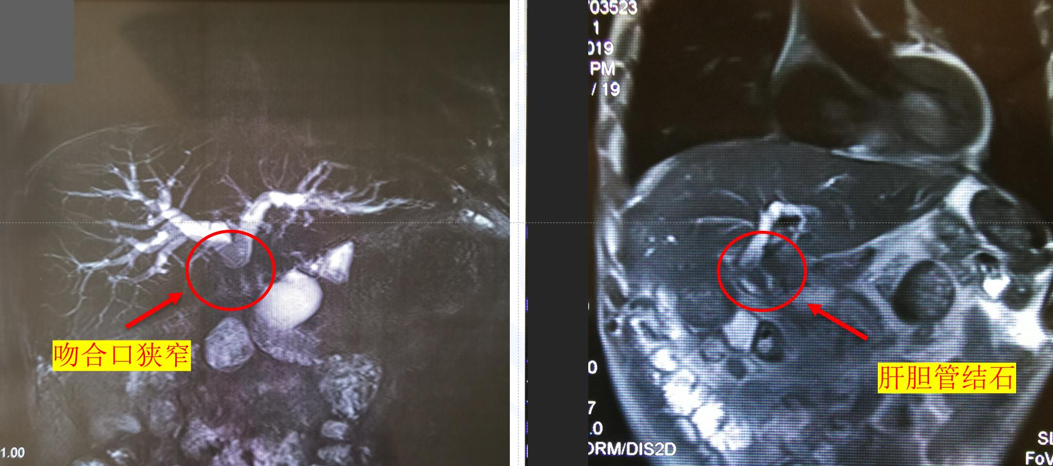 胆肠吻合术后胆瘘怎么处理,胆肠吻合口狭窄术后还会复发吗