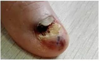 小小的指甲隐藏大大的健康秘密,小小指甲大调查