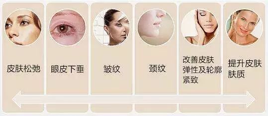 超声刀能抚平皱纹吗,超声刀让人更快衰老吗