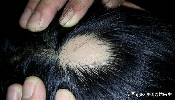 一块一块的脱发是咋回事呀,突然大面积脱发斑秃怎么办