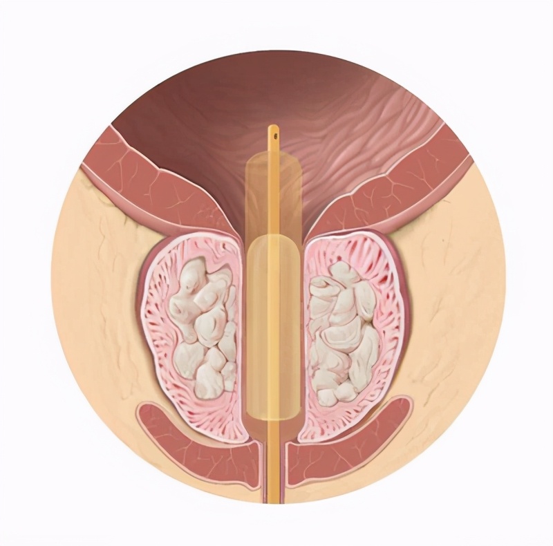 西安市红会医院泌尿外科,陕西红会医院泌尿科