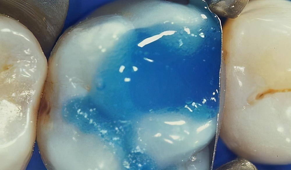 补牙里面灌的水,补牙水很深