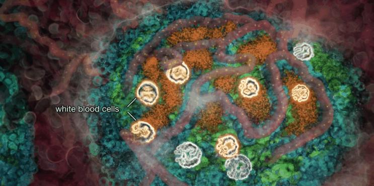 胰岛素是如何导致糖尿病的,胰岛素增多为什么会导致糖尿病