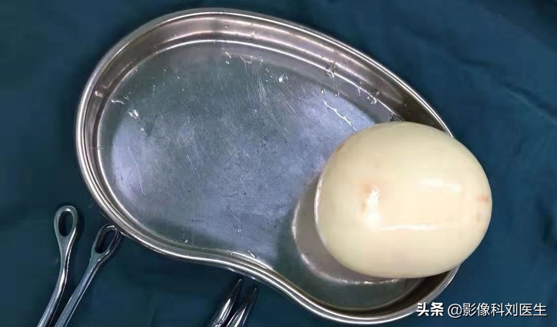 鸭蛋吃多了肚胀气有什么办法,鸭蛋烂在肚子里怎么办