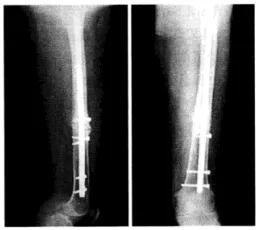一文讲透，创伤骨科中常用的髓内钉