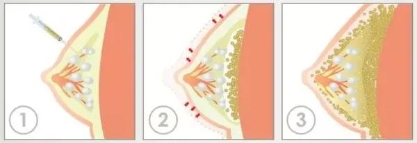 自体脂肪隆胸两年后的忠告,平胸可以做自体脂肪隆胸吗