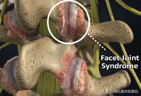 游泳腰痛应该停止游泳吗,游泳腰疼