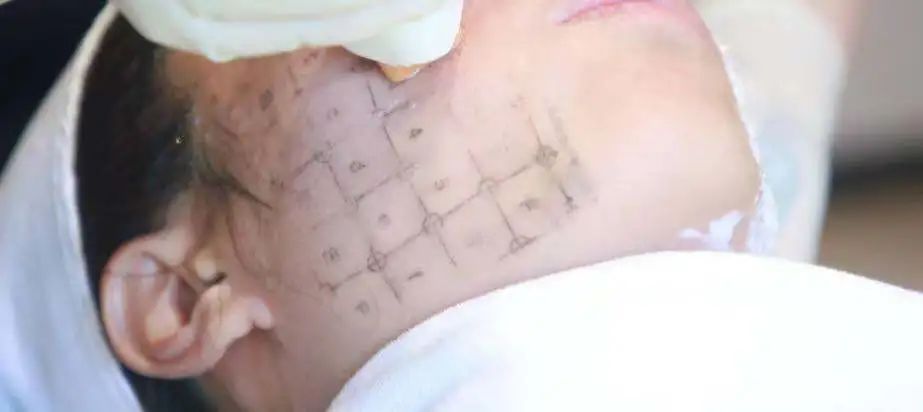 无痛热玛吉多少钱一次,无痛热玛吉效果多久才出来