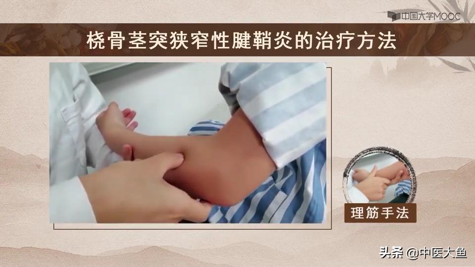 桡骨茎突狭窄性腱鞘炎怎么治疗,桡骨茎突狭窄性腱鞘炎治疗方法